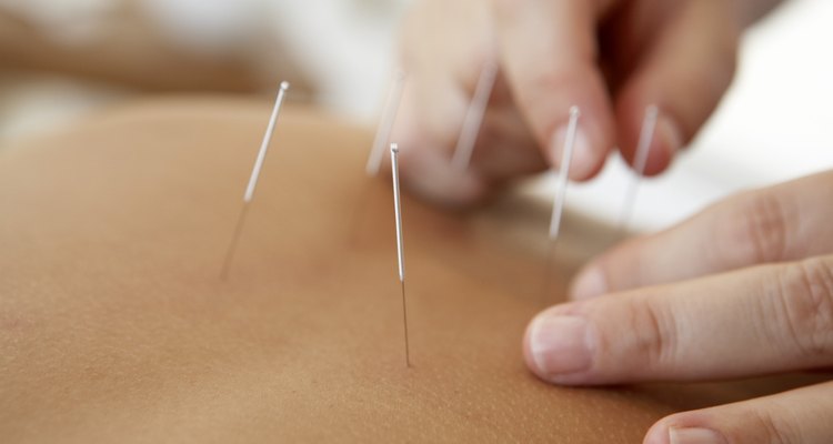 A acupuntura pode ser uma forma de tratamento eficaz para a neuropatia periférica