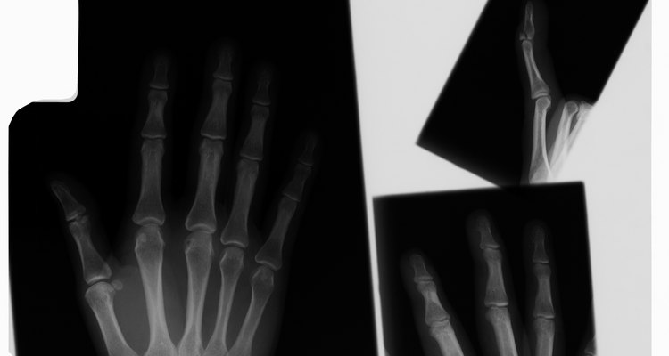 Un dedo quebrado puede tardar hasta seis semanas en curar.