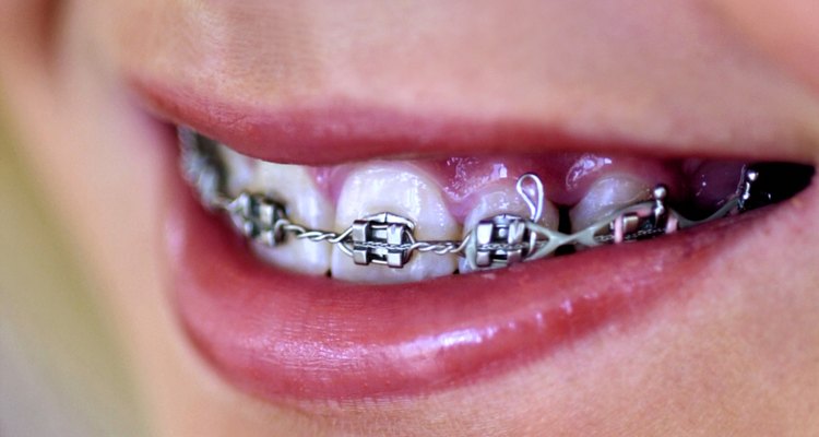 Aparelhos dentários ajudam a alinhar os dentes