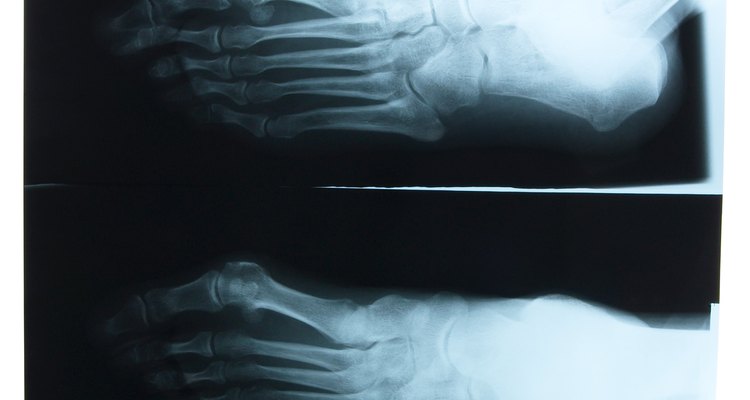 A recuperação de uma cirurgia de tornozelo deve ser muito cuidadosa