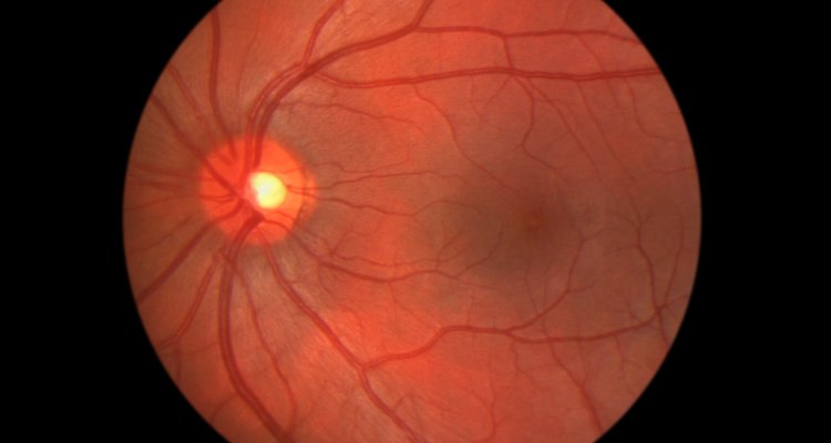 Desprendimiento de retina: síntomas y tratamiento