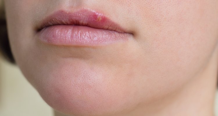 Cómo curar el herpes labial
