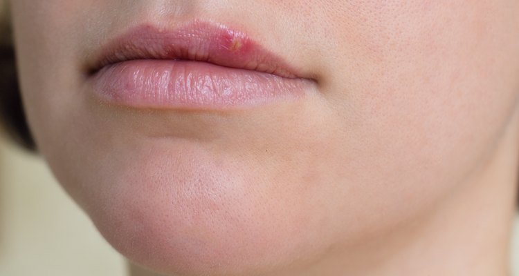 C Mo Curar El Herpes Labial Portal Salud