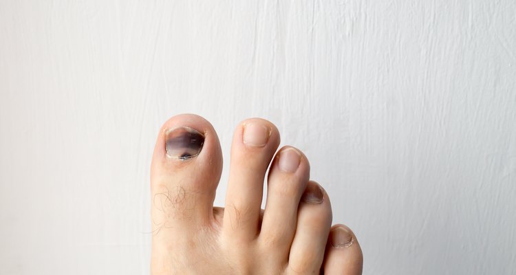 Causas de las manchas negras en las uñas de los pies | Portal Salud