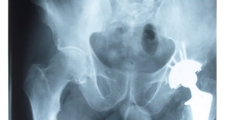 La presencia de cualquier tipo de calcificación pélvica es típicamente confirmada a través de rayos X.