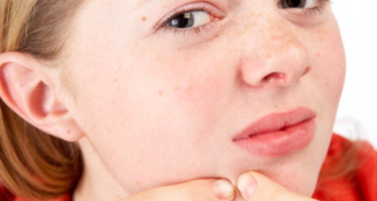 La pomada de azufre se usa para tratar el acné y otras condiciones de la piel, pero algunas personas le tienen alergia.