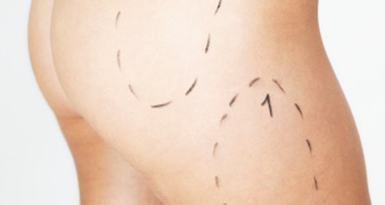 Es importante comenzar a moverse pronto después de una cirugia de liposucción para promover la circulación y prevenir coágulos de sangre.