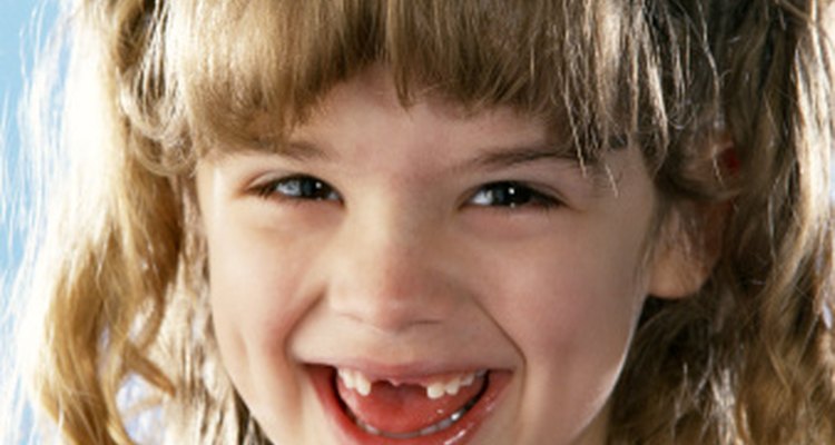 Las dentaduras parciales de acrílico se usan para rellenar agujeros temporalmente.