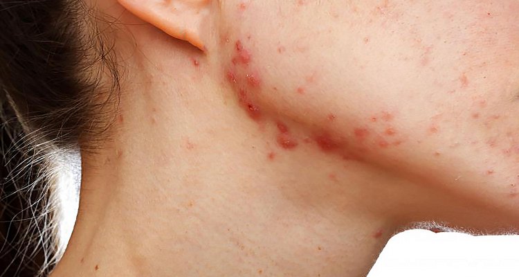 A combinação de dois produtos potencialmente irritantes podem danificar a pele