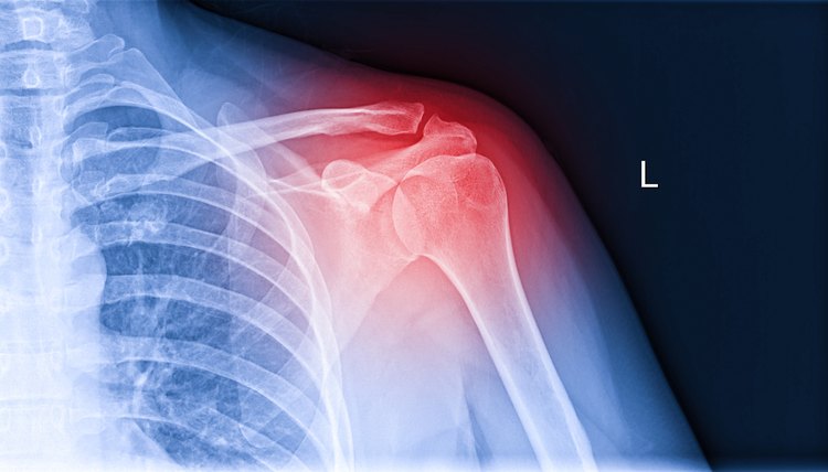 X-ray image of shoulder pain, shoulder ligament tendinitis, shoulder muscle strain