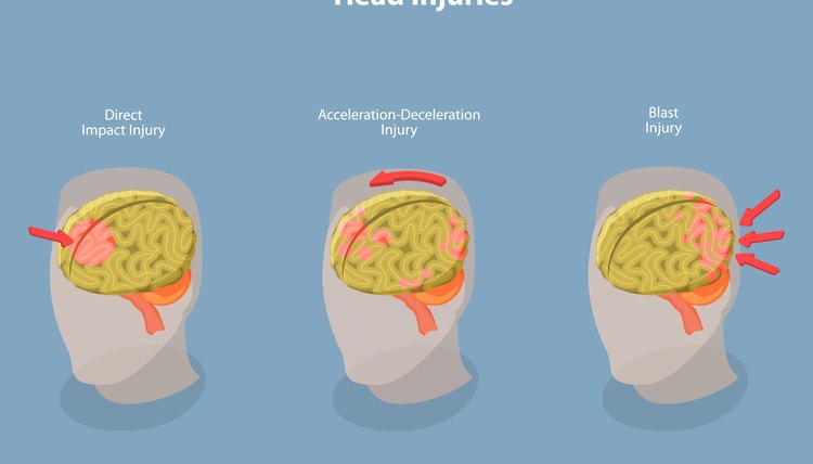 3D Isometric Flat Vector Conceptual Illustration of Brain Injuries