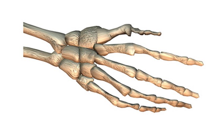 The acutrak screw holds carpal wrist bone fractures.