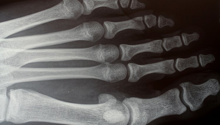 The Herbert screw is used to hold small fractured bones as in feet and hands.