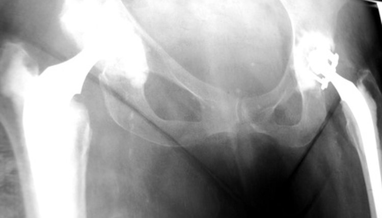 Dynamic hip screws compacts the damaged bone together.
