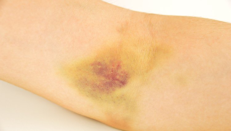 closeup of a bruise