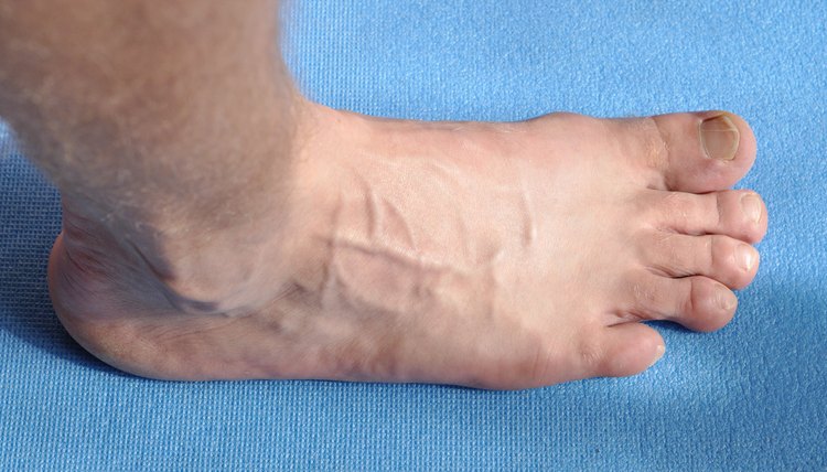 Toenail fungus with varicose veins