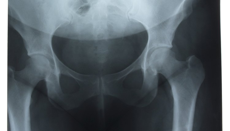 X-ray of hips
