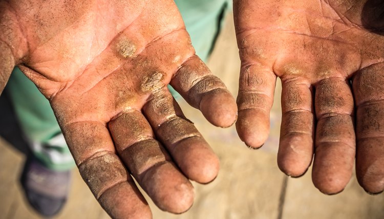 Injured open palms