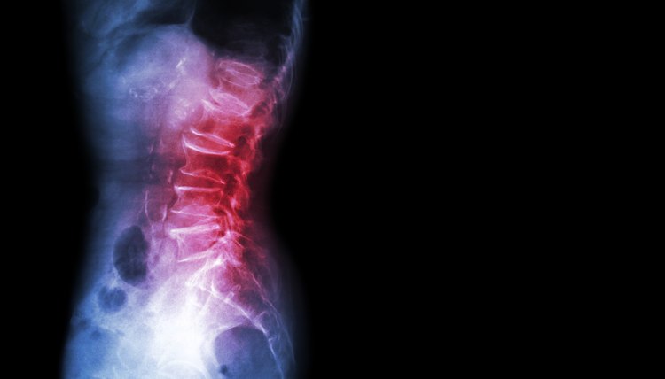 Spondylosis , Spondylolisthesis  ( Film x-ray lumbo - sacral spine show spine collapse , decrease in disc space , bony spur formation ) ( side , lateral view ) and blank area at right side
