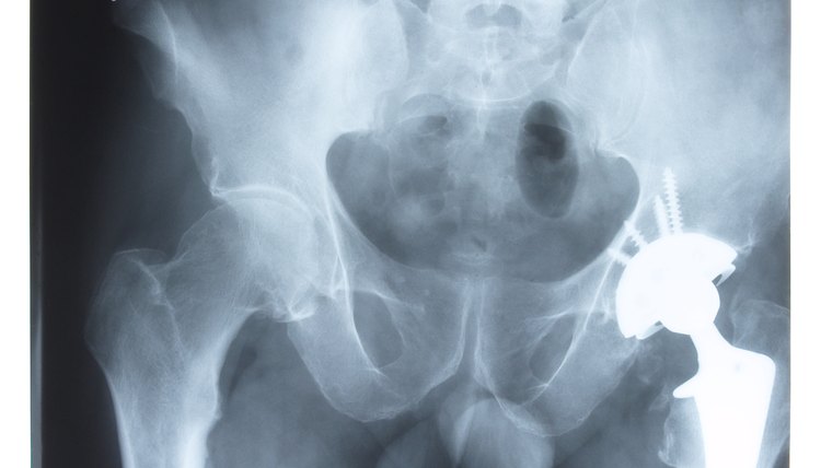 X-ray of pelvis
