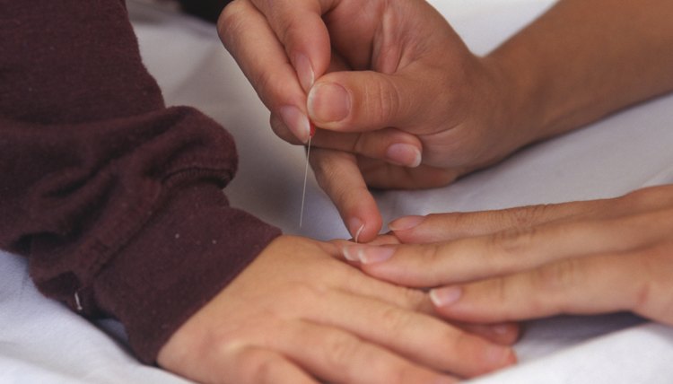 Person having acupuncture on hands, close-up