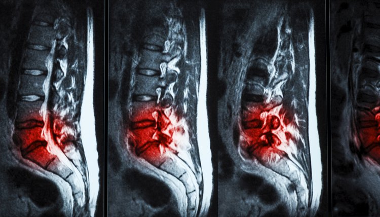 Herniated Disk Exercises for L5-S1 | SportsRec