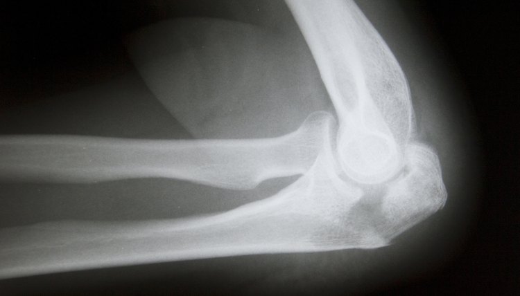 Broken Elbow X-Ray Picture