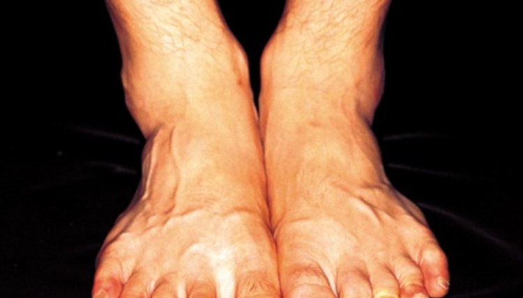 Peroneal Tendonitis Exercises Using Thera-Band