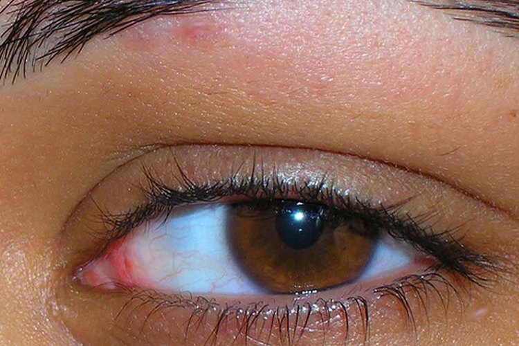 Un tratamiento para curar hinchazón y picazón en los ojos es díficil.