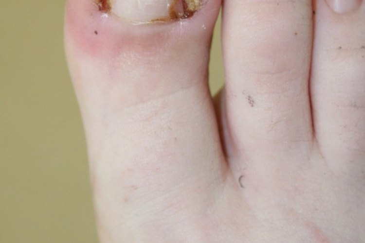 Dolor, enrojecimiento, inflamación e infección pueden producirse.