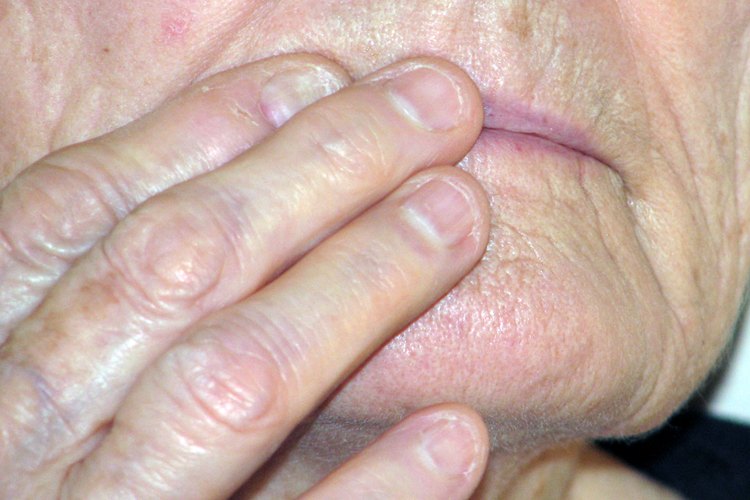 El herpes labial no se puede prevenir o curar, pero se puede limitar su duración.