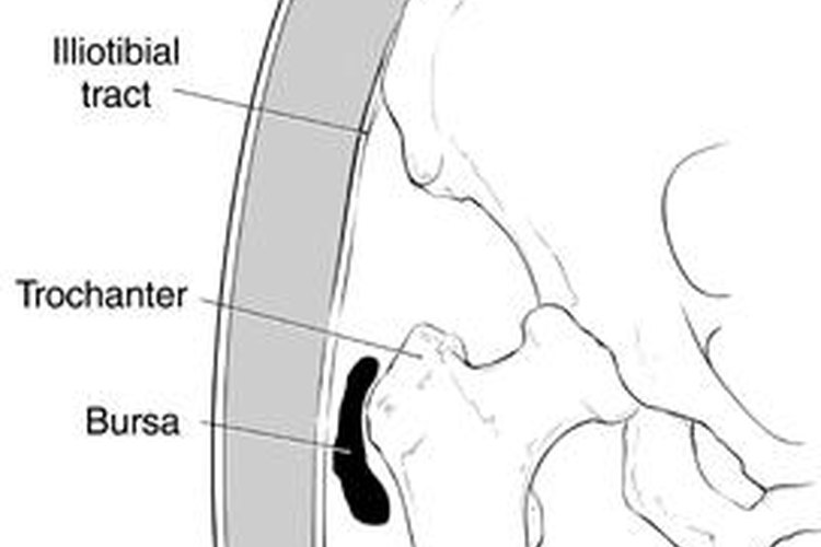 La bursitis se produce cuando este saco se irrita y se inflama.