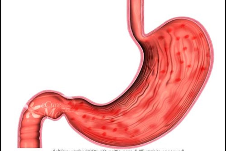 Una dieta saludable puede ayudar a aliviar los síntomas de la gastritis.