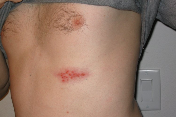 A medida que envejeces, el debilitamiento de tu sistema inmunológico puede llevar a su resurgimiento como una erupción que puede causar dolor e irritación de los nervios.