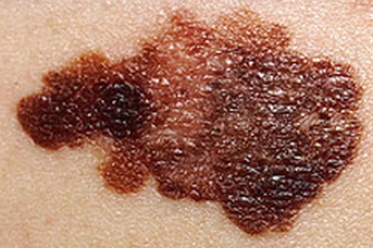 Cómo reconocer el comienzo del cáncer de piel.