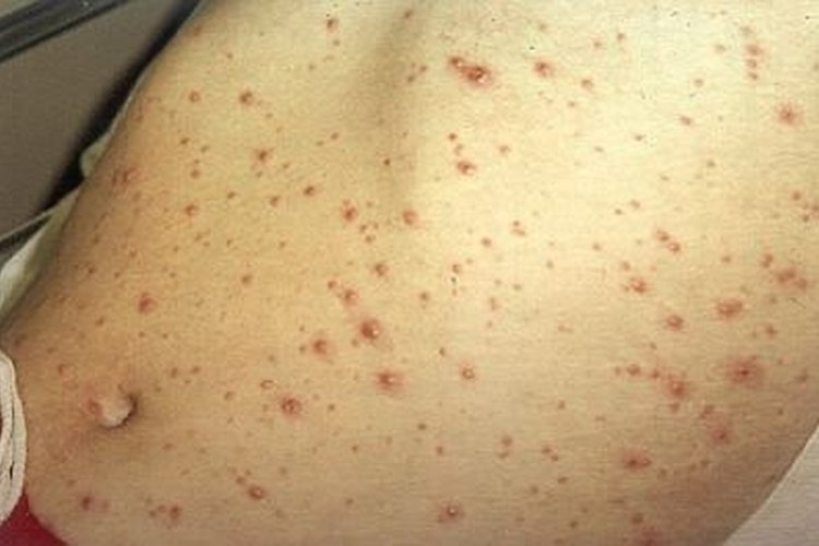 Fade Chicken Pox Scars