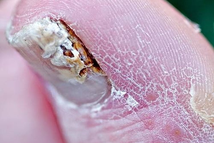 Fungus on the toenails