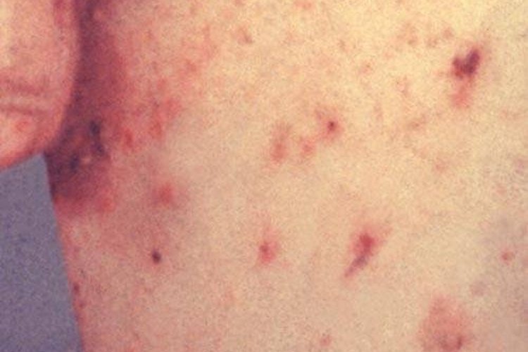 Scabies rash