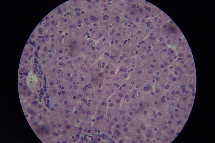La cirrosis o cicatrización del hígado, es la reacción del cuerpo a un daño hepático crónico.