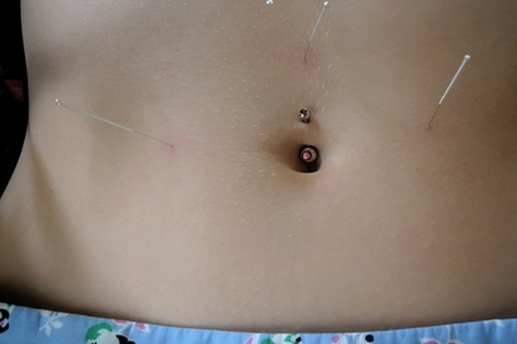 Acupuncture is an alternative medicine often used to treat infertility.