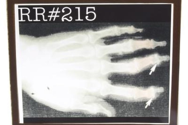 X-ray of an arthritic hand