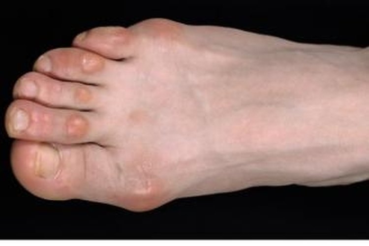 How to Use Bread & Lemon to Remove Calluses and Corns