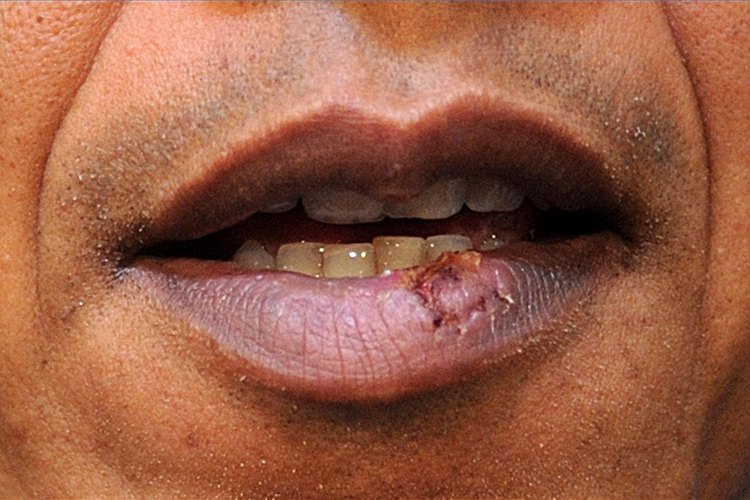 is it safe to take valacyclovir everyday for cold sores