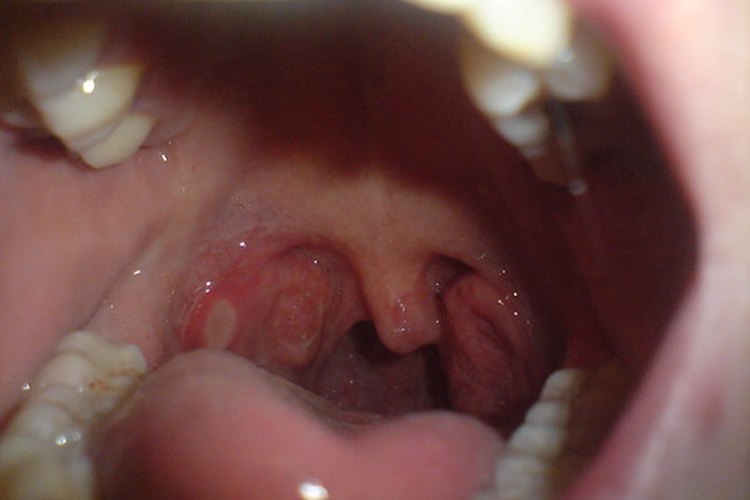 Faringitis estreptocócica con manchas blancas.