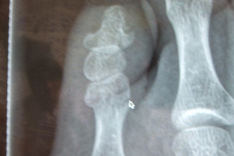 Los suplementos de glucosamina pueden ayudar a aliviar el dolor de la osteoartritis.