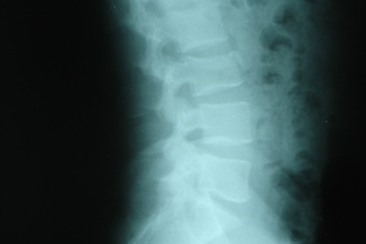 La mayoría de las hernias de disco ocurren en la espina lumbar.