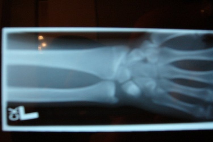 Radiografía del antebrazo.