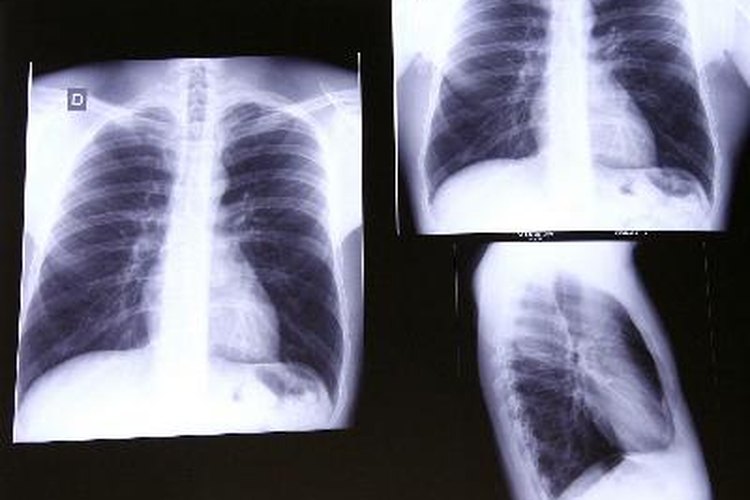 Existen diferentes etapas relacionadas con la gravedad del asma.