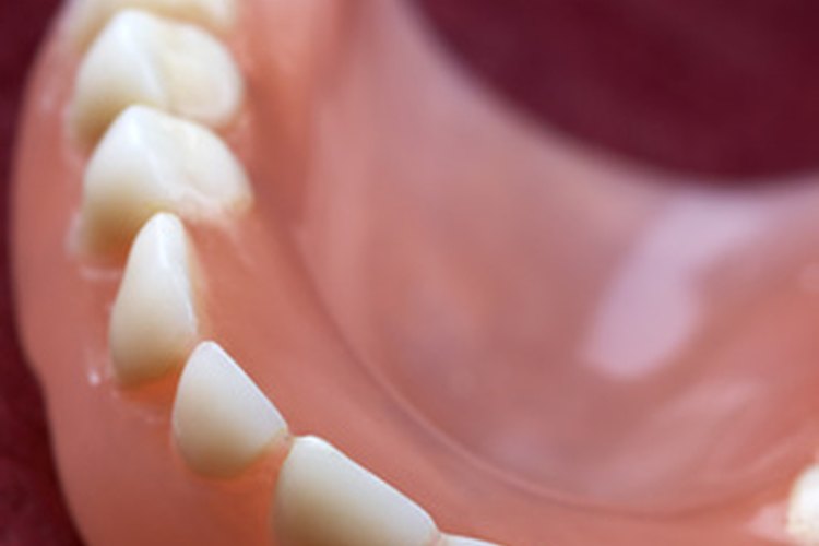 Una dentadura en ocasiones es sostenida por un implante dental.