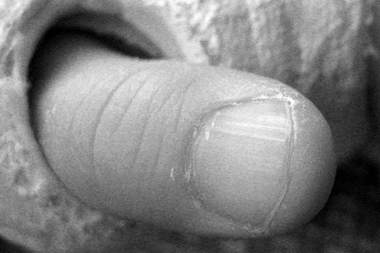 Lesión en el ligamento del pulgar puede resultar en enyesamiento necesario por varias semanas.